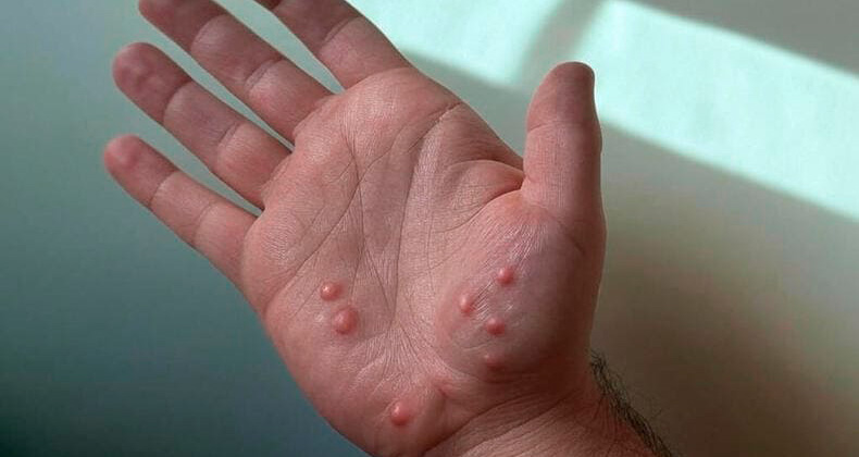 mpox